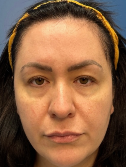 Blepharoplasty Before & After Patient #12491
