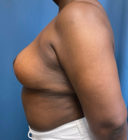 Breast Reduction Before & After Patient #12692