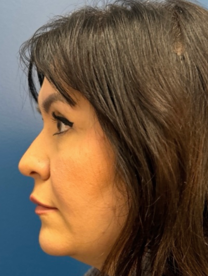 Blepharoplasty Before & After Patient #12491