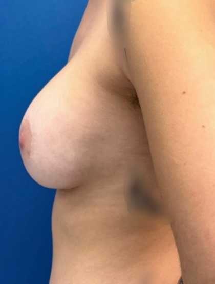 Breast Augmentation Before & After Patient #12480