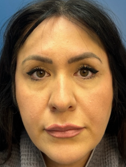Blepharoplasty Before & After Patient #12491