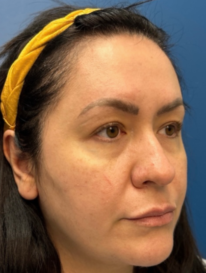 Blepharoplasty Before & After Patient #12491