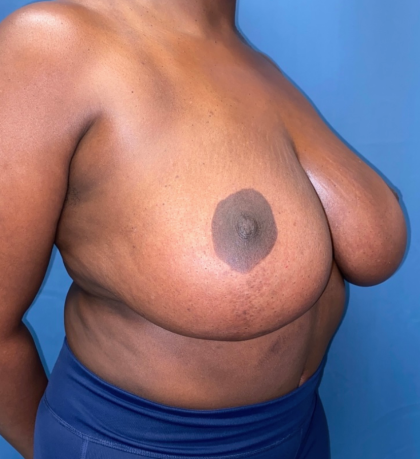 Breast Reduction Before & After Patient #12692