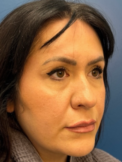 Blepharoplasty Before & After Patient #12491