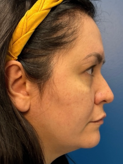 Blepharoplasty Before & After Patient #12491