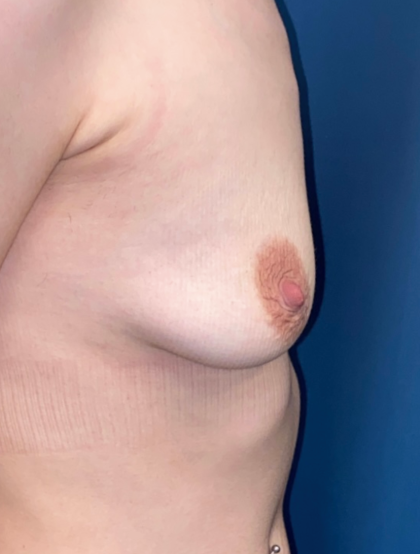 Breast Augmentation Before & After Patient #12480