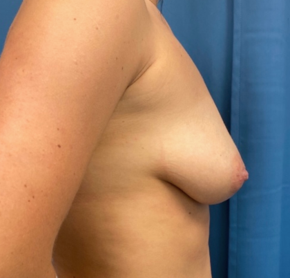 Breast Augmentation Before & After Patient #12609