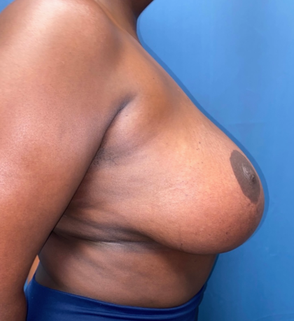 Breast Reduction Before & After Patient #12692