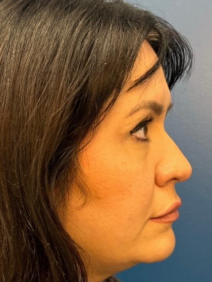 Blepharoplasty Before & After Patient #12491