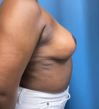 Breast Reduction Before & After Patient #12692