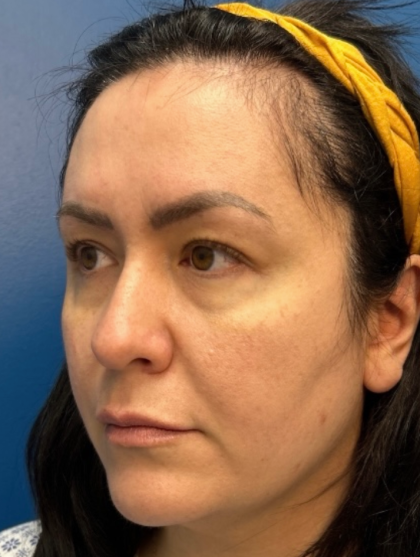 Blepharoplasty Before & After Patient #12491