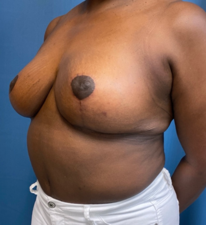 Breast Reduction Before & After Patient #12692
