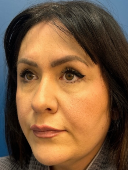 Blepharoplasty Before & After Patient #12491