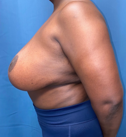Breast Reduction Before & After Patient #12692