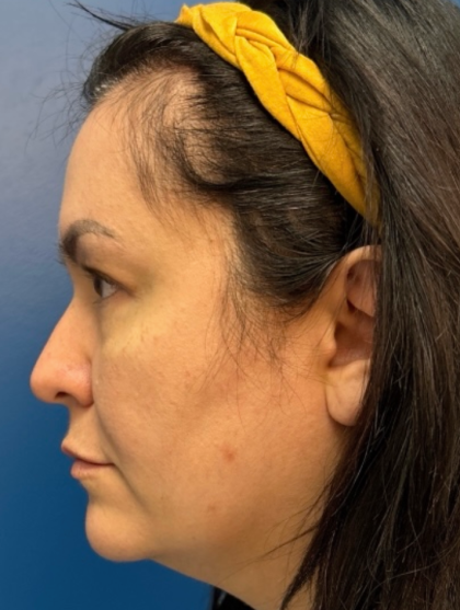 Blepharoplasty Before & After Patient #12491