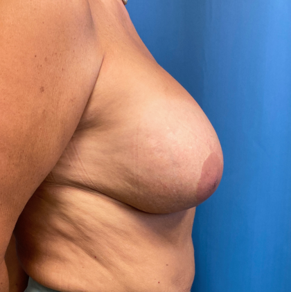 Breast Revision Before & After Patient #12547
