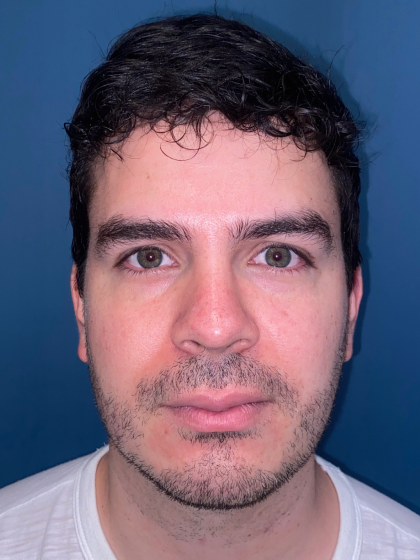 Buccal Fat Removal Before & After Patient #12812