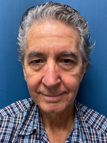 Facelift and Necklift Before & After Patient #12788