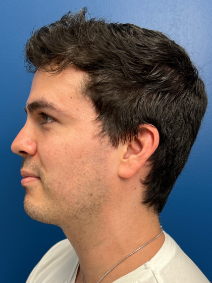Buccal Fat Removal Before & After Patient #12812