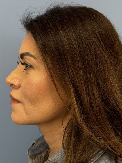 Lip Lift Before & After Patient #12830