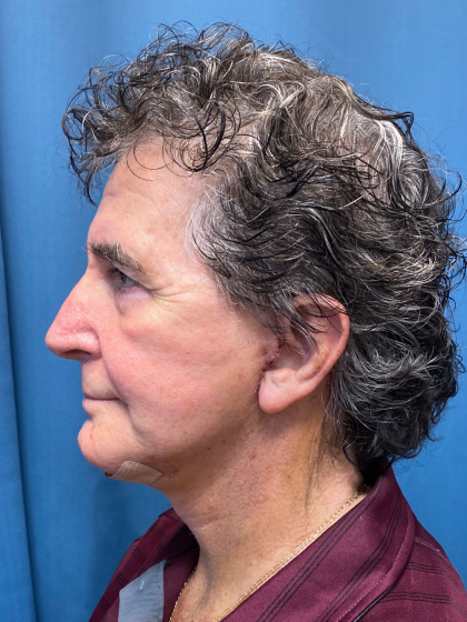 Facelift and Necklift Before & After Patient #12788
