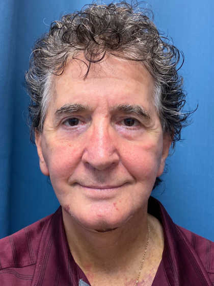 Facelift and Necklift Before & After Patient #12788