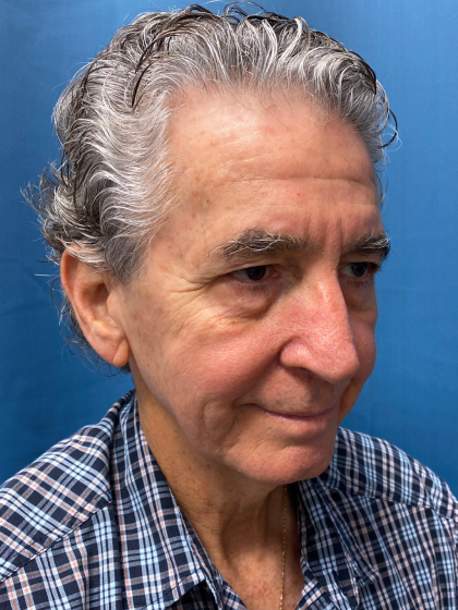 Facelift and Necklift Before & After Patient #12788