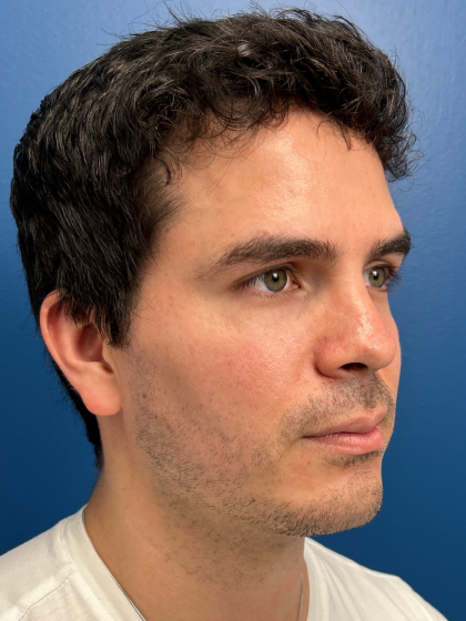 Buccal Fat Removal Before & After Patient #12812