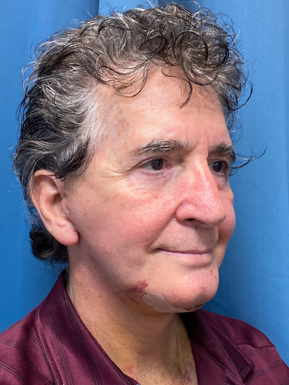 Facelift and Necklift Before & After Patient #12788