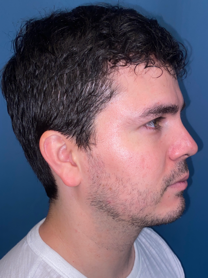 Buccal Fat Removal Before & After Patient #12812