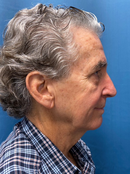 Facelift and Necklift Before & After Patient #12788