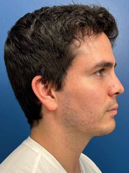 Buccal Fat Removal Before & After Patient #12812