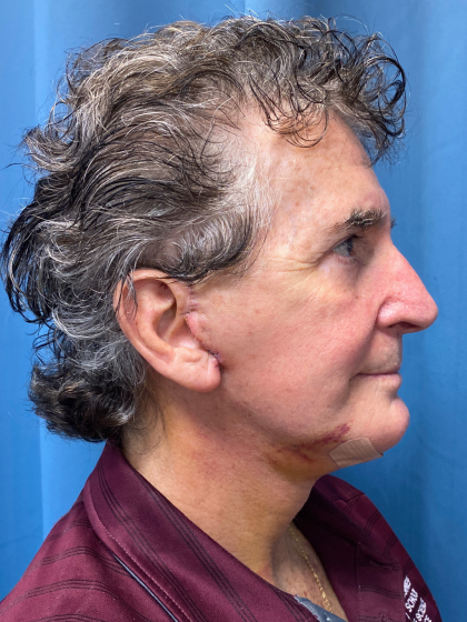 Facelift and Necklift Before & After Patient #12788