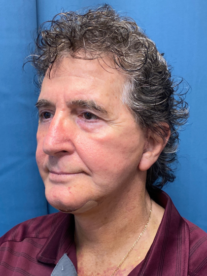 Facelift and Necklift Before & After Patient #12788