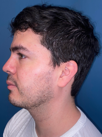 Buccal Fat Removal Before & After Patient #12812