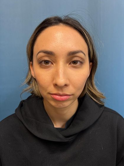 Chin Implant Before & After Patient #13302