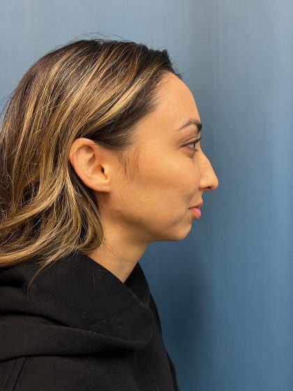 Chin Implant Before & After Patient #13302