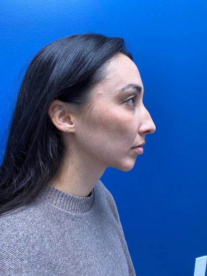 Chin Implant Before & After Patient #13302