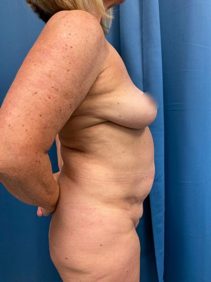 Tummy Tuck Before & After Patient #13248