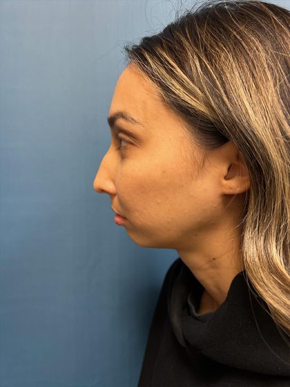 Chin Implant Before & After Patient #13302