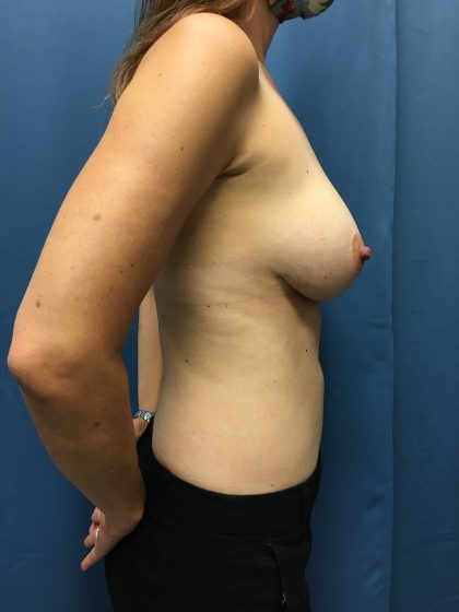 Breast Revision Before & After Patient #13374