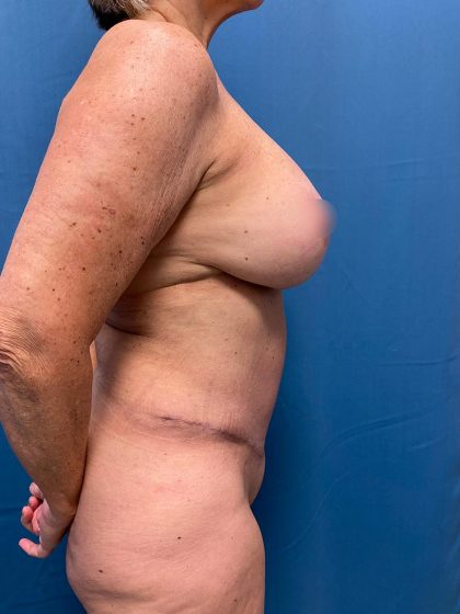 Tummy Tuck Before & After Patient #13248