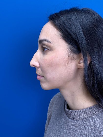 Chin Implant Before & After Patient #13302