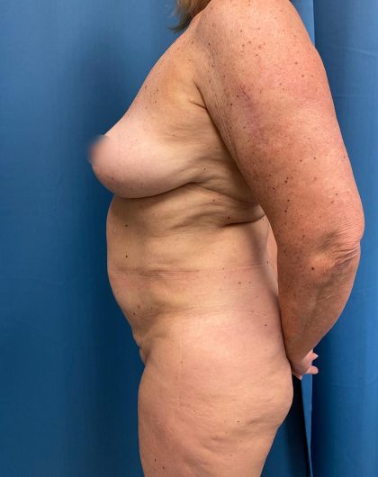 Tummy Tuck Before & After Patient #13248