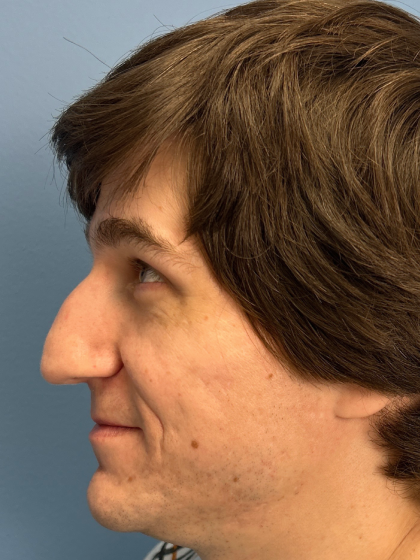 Rhinoplasty Before & After Patient #12901