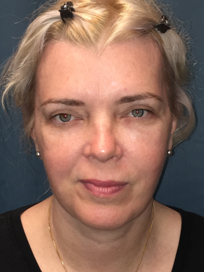 Facelift and Necklift Before & After Patient #13012