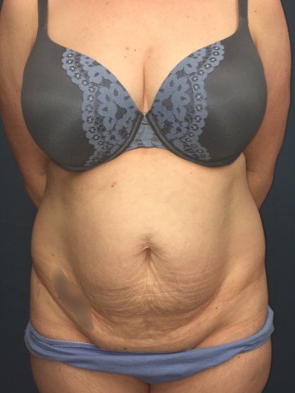 Tummy Tuck Before & After Patient #13015