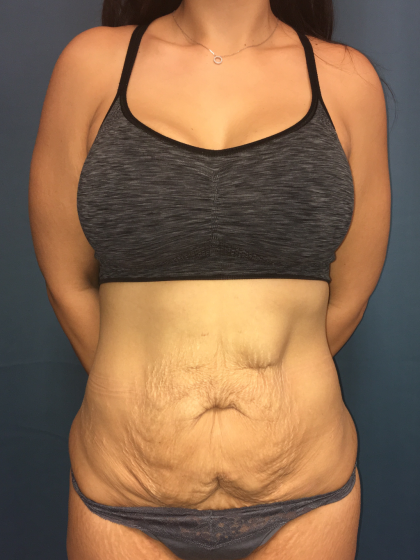 Tummy Tuck Before & After Patient #13016