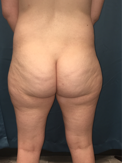 Liposuction Before & After Patient #13017