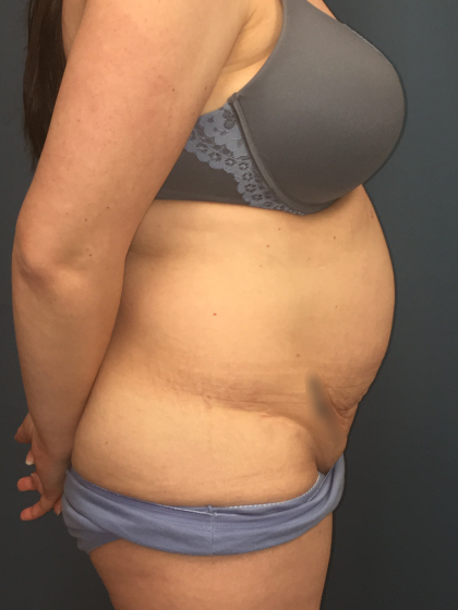 Tummy Tuck Before & After Patient #13015